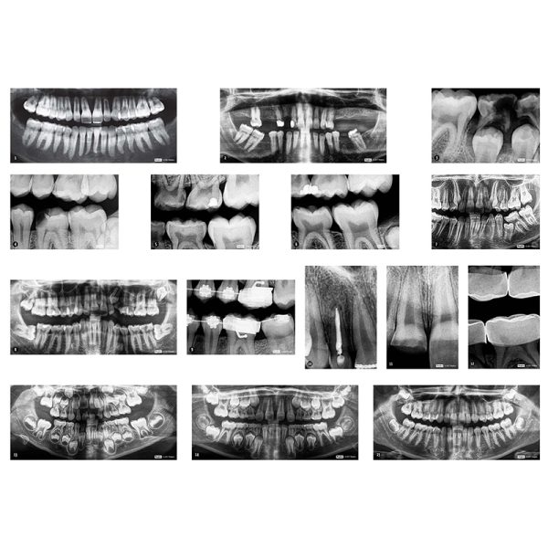 Dental X-Rays